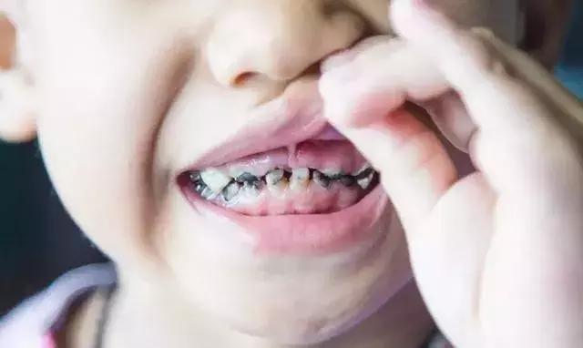 2岁半宝宝牙齿摔掉了一半,2岁半儿童牙齿坏了