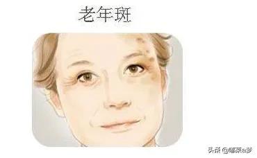 雀斑晒斑怎么去除中医,晒斑怎么祛斑最有效既省钱又简单