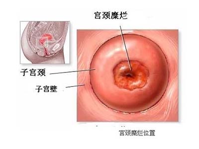 宫颈糜烂影响生育吗影响备孕,宫颈糜烂在备孕上需要注意些什么