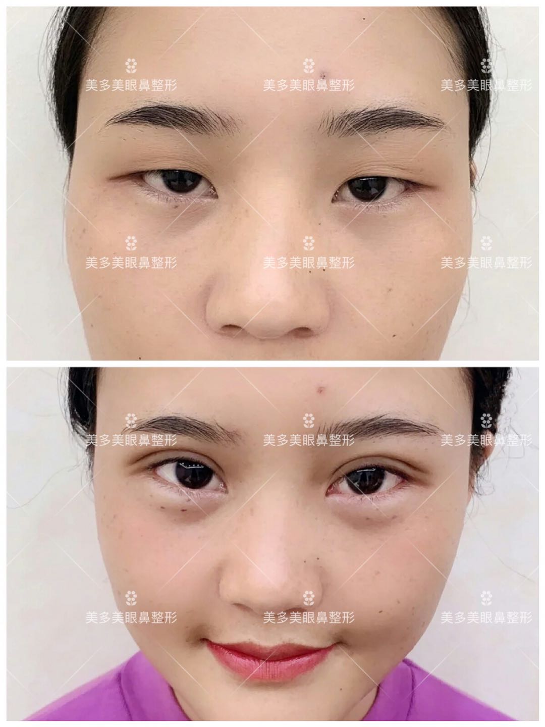 双眼皮手术睁眼闭眼效果,双眼皮手术怎么看着不假