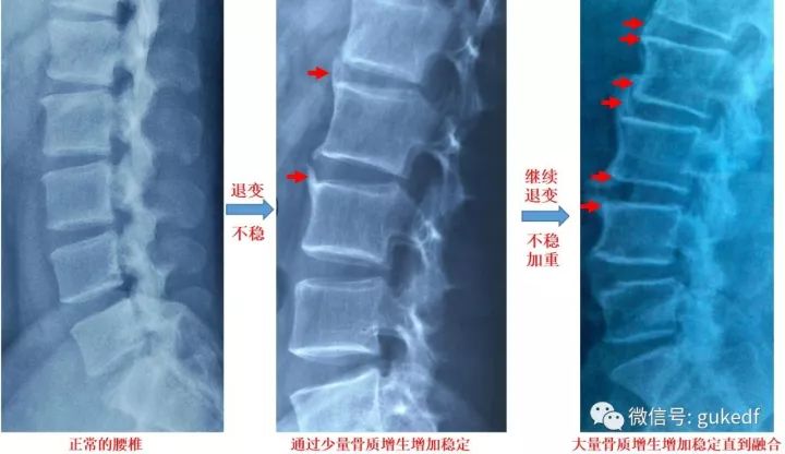 什么叫做骨刺骨刺都长在什么地方,膝盖长骨刺怎么去掉骨刺