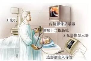 西青医院普通外科医疗团队连续运用ERCP微创技术治疗高危难病患