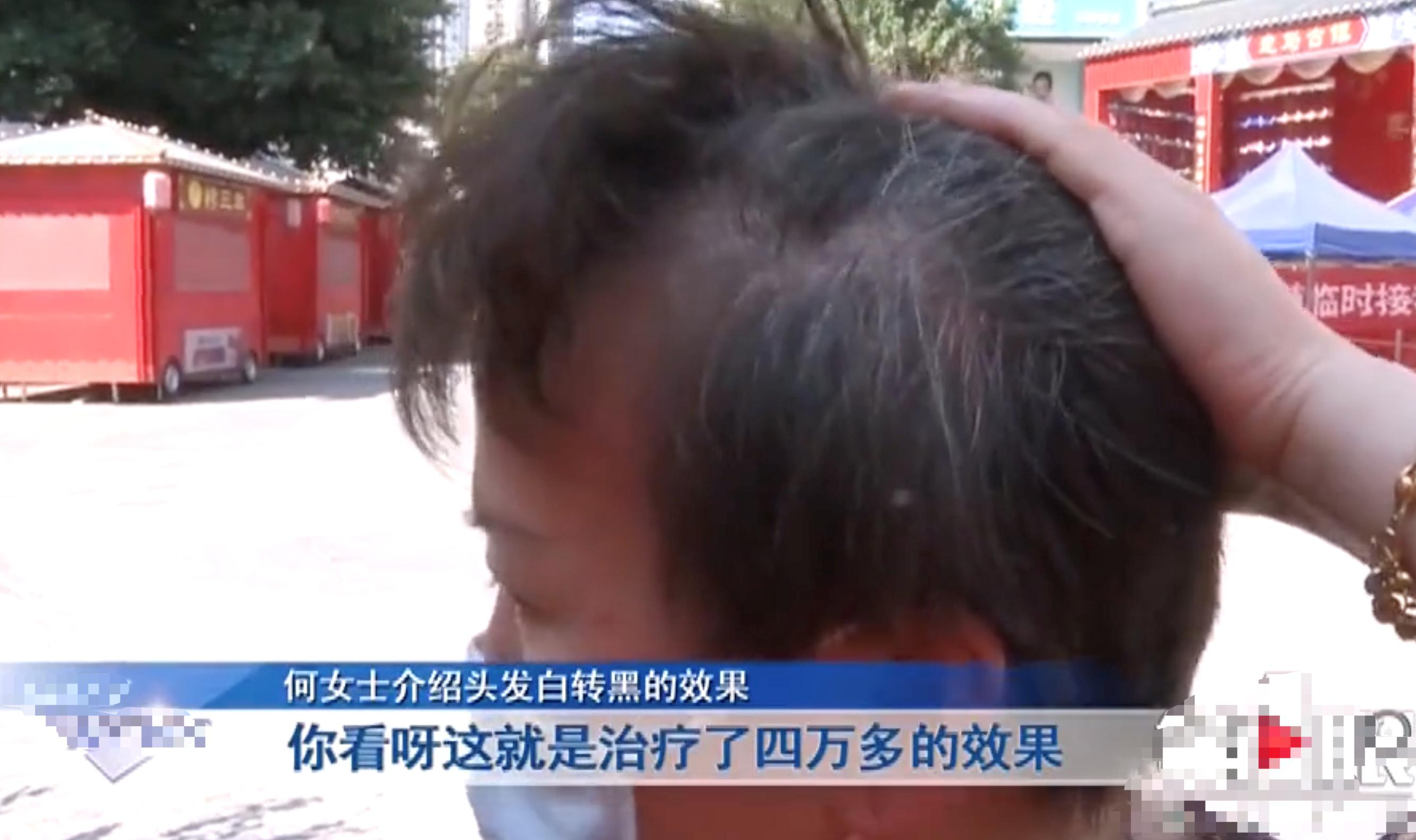 女子花4万治疗白发后续,女子花4万做白发转黑发后续