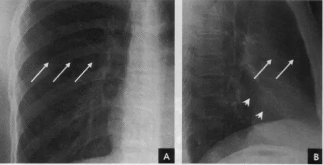 x线影像解剖大全,胸部x线怎么看懂图解