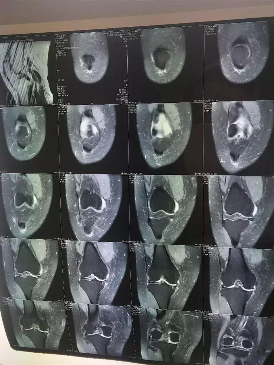 换膝盖关节手术有瘫痪风险吗,换膝手术可以百万医疗理赔吗