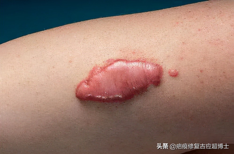 瘢痕疙瘩手术加放疗复发几率,瘢痕疙瘩手术百分百复发吗