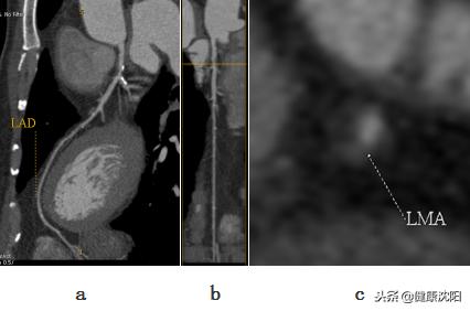 cta和血管造影怎么选择,血管oct检查与血管造影检查的区别