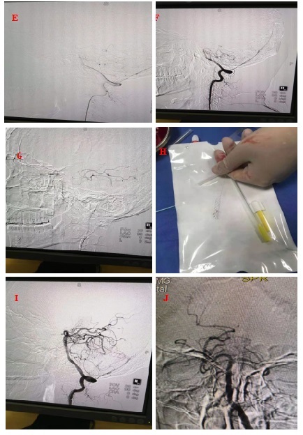 脑梗死错过黄金救治溶栓窗口期,脑梗抢救黄金时间消栓术