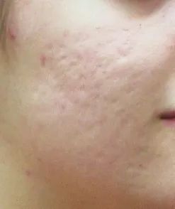 多年黑痘印痘坑消除的方法,红痘印黑痘印痘坑怎么修复