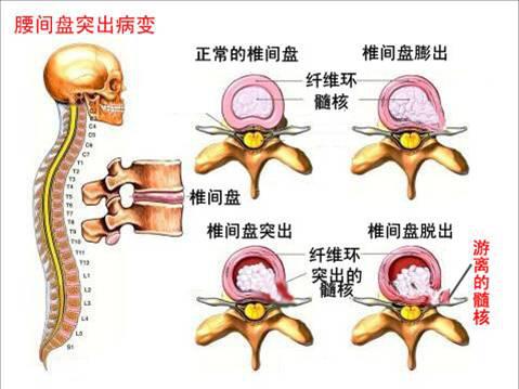 骨科医生告诉你：腰椎间盘突出、膨出、脱出都有什么区别？