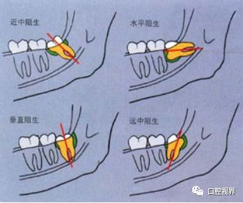 老年人拔牙后注意事项要牢记,糖尿病拔牙后注意事项与禁忌