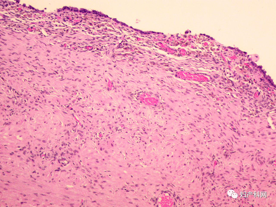 子宫内膜异位囊肿报告如何看,病理报告显示卵巢子宫内膜囊肿