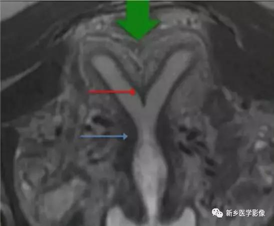 子宫发育异常，应想到的6大类常见畸形