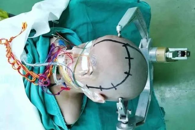 儿童脑肿瘤头痛和普通头痛的区别,小孩脑肿瘤晚期头痛怎么处理