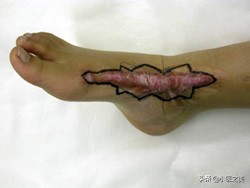 烫伤，以正确的方式治疗可帮助减轻疤痕增生