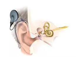 打孔埋线,一步搞定!马斯克的“赛博格”变身方案来了