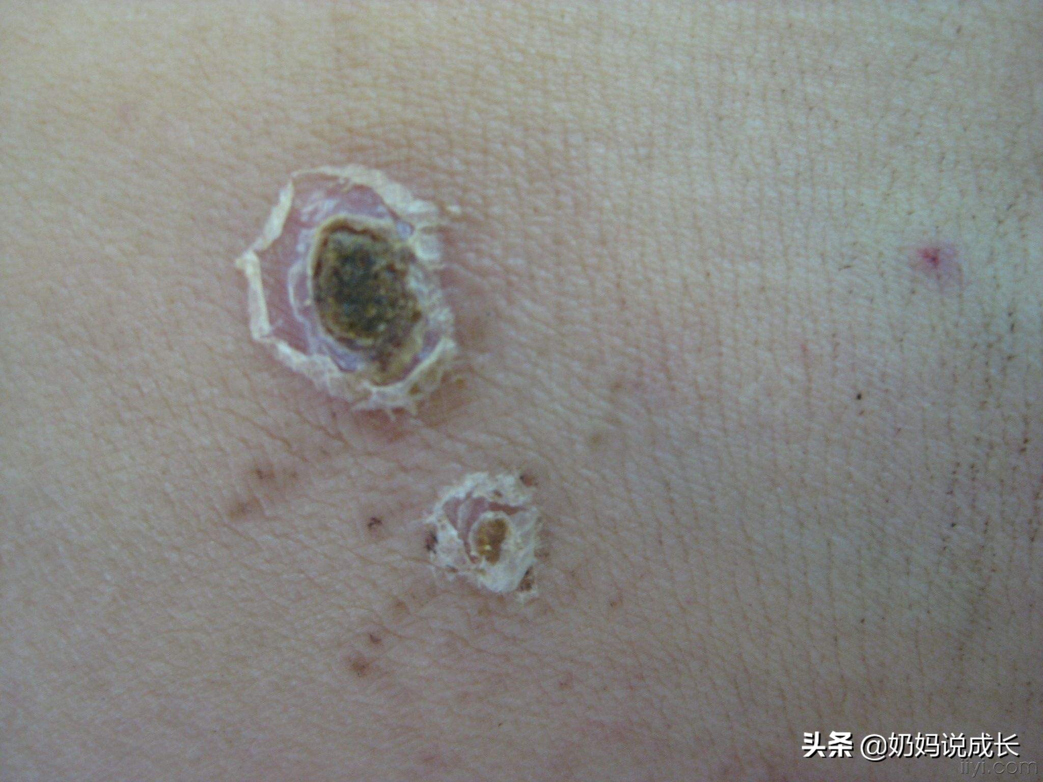 男孩“*处私**被咬”差点危及生命,要命的“*虫病恙**”家长要引起重视