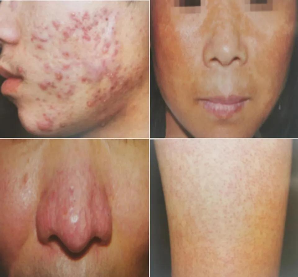 皮肤科医生建议刷酸,皮肤科医生刷酸详细步骤