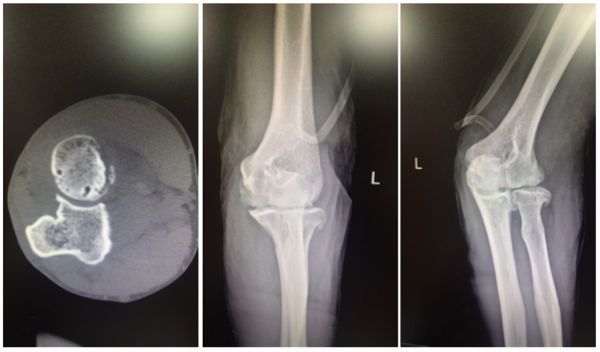 痛风踝关节炎症状,痛风关节炎早发现早治好