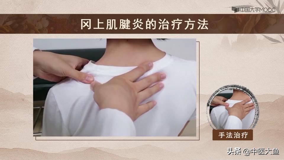 冈上肌腱炎的体征,冈上肌肌腱炎的症状及治疗