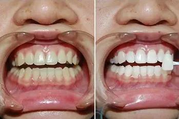 反复美白对牙齿有什么危害,牙齿美白对牙齿有什么危害