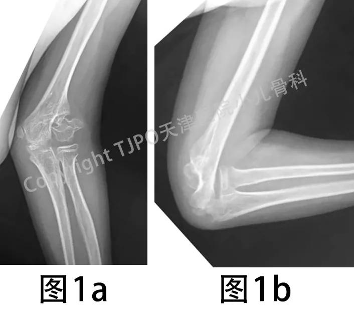 肱骨髁上骨折如何预防肘外翻畸形,肱骨髁上骨折外翻畸形原因
