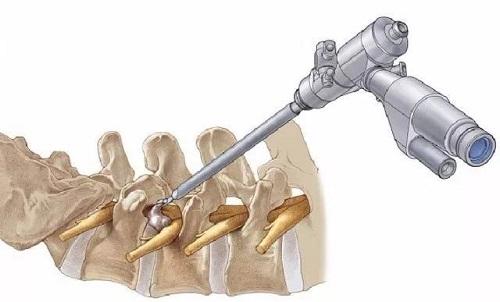 肩膀颈椎疼痛手臂发麻怎么缓解,颈椎病压迫手臂麻木吃什么药