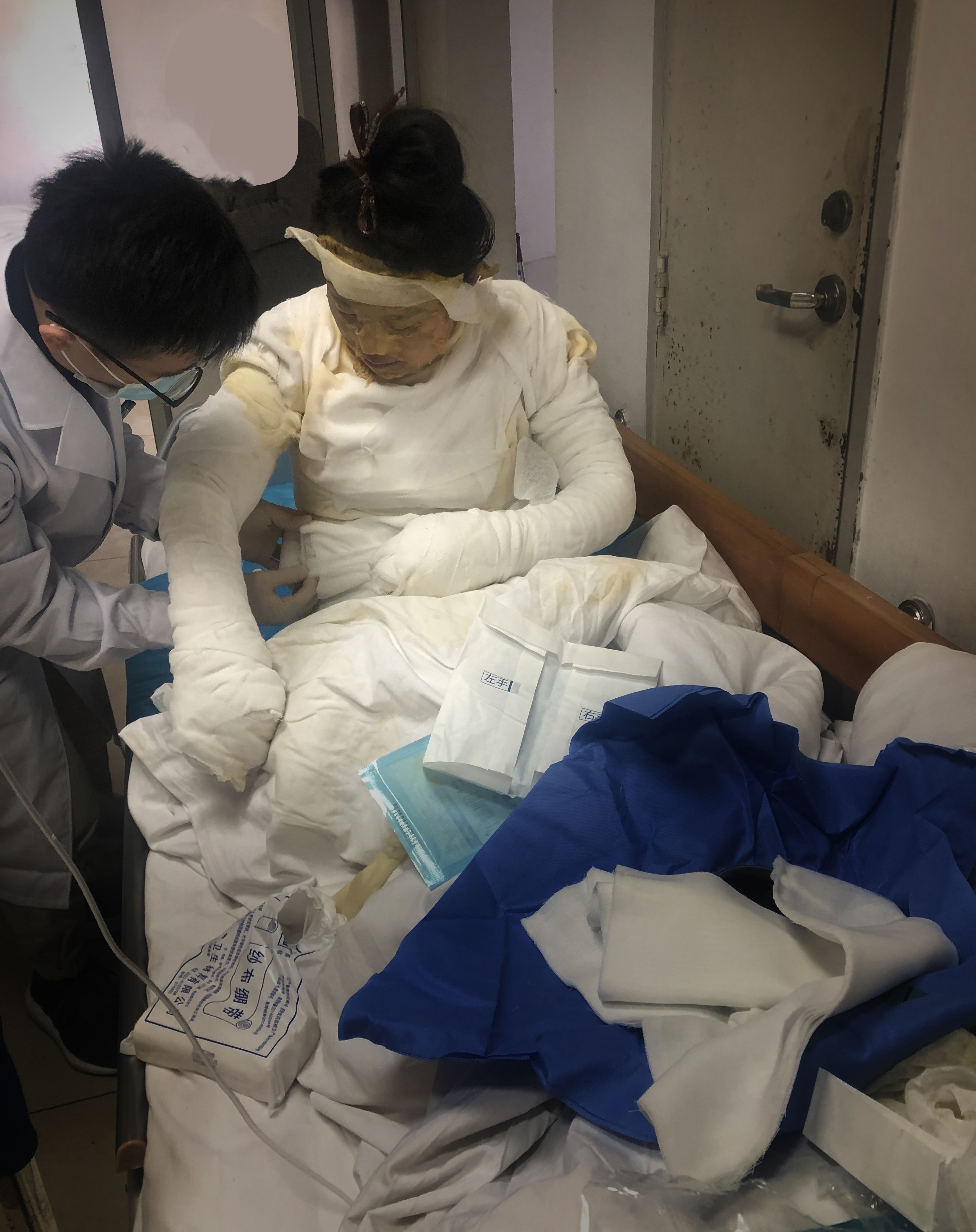 美女辣妈拔火罐烧伤如戴紧箍咒,美妈凌晨拔火罐烧伤