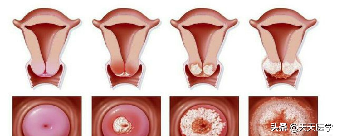 宫颈癌发生时的症状有那些,来了解一下