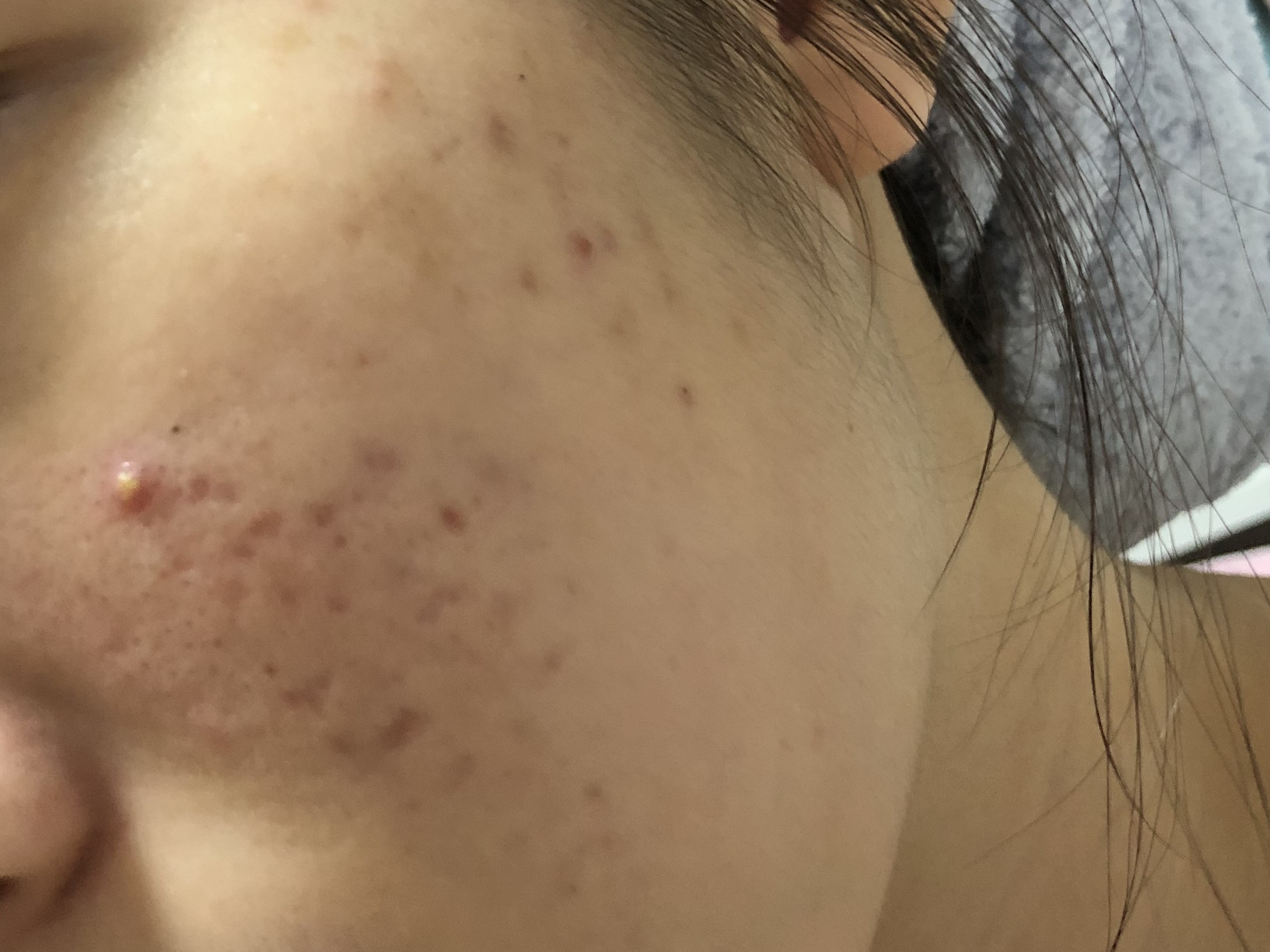 17岁女儿脸上长很多痘痘粉刺,12岁女儿脸上长满痘痘怎么办