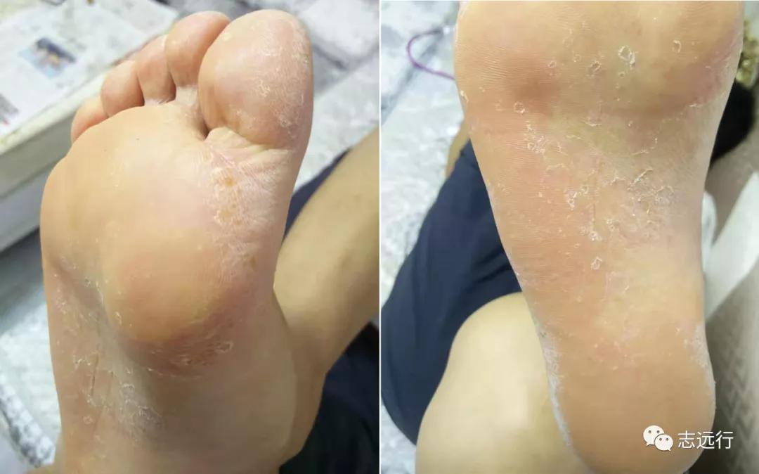 张景明治疗手足癣的中药方,手足癣单方大全