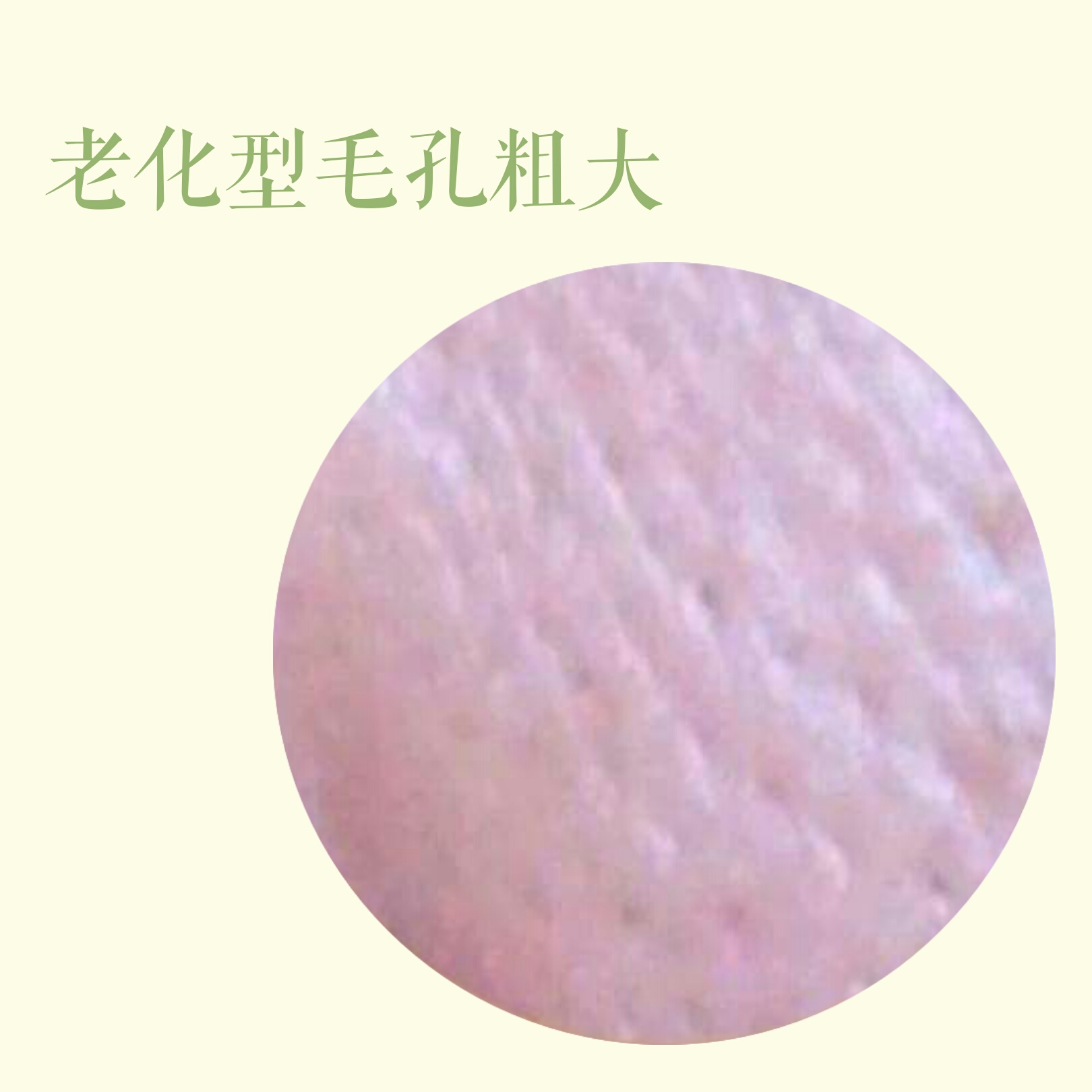 毛孔粗大怎么办给你最全护理指南,目前解决毛孔粗大最有效的手段