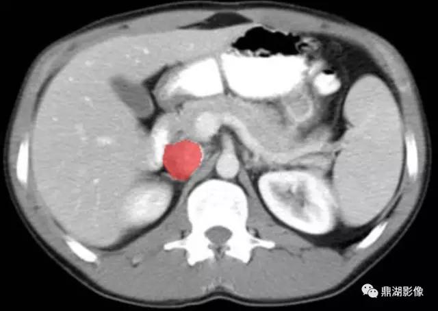 颈部胸锁乳突肌ct断层解剖图,骨盆骨质正常断层ct解剖图解