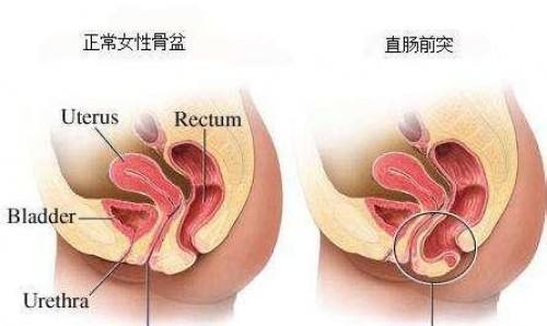 肛门、直肠狭窄的原因及分类