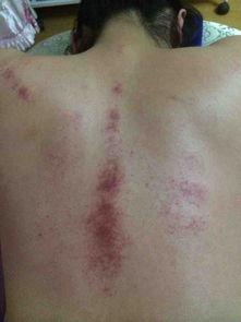 太原针灸科医生排名,太原中医针灸医院