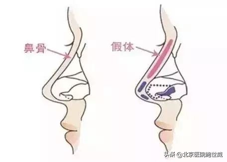 隆鼻后假体外露会有什么表现,假体隆鼻外露怎么修复