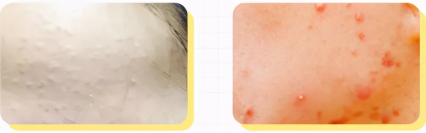 长闭口了怎么办！告诉你答案哦