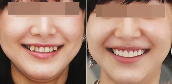 为什么有些人会长獠牙,为什么有的人成年了还会长牙