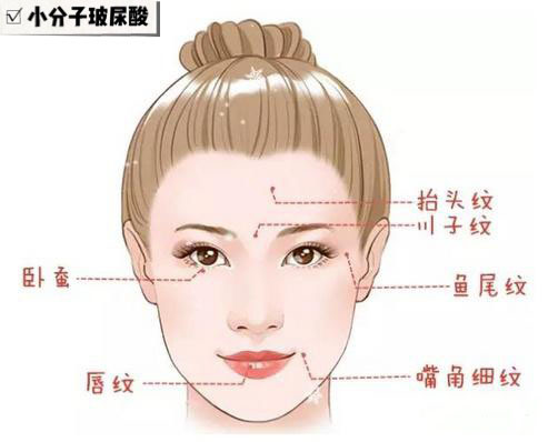 注射玻尿酸品牌十大排行榜,玻尿酸补水保湿推荐哪款