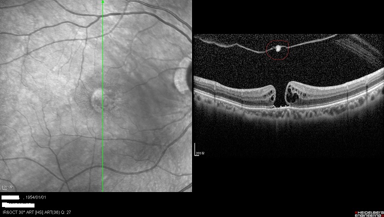 眼球晶体破洞,眼球裂缝是什么原因造成的
