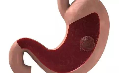 什么情况下有息肉会癌变,哪些部位长息肉最严重