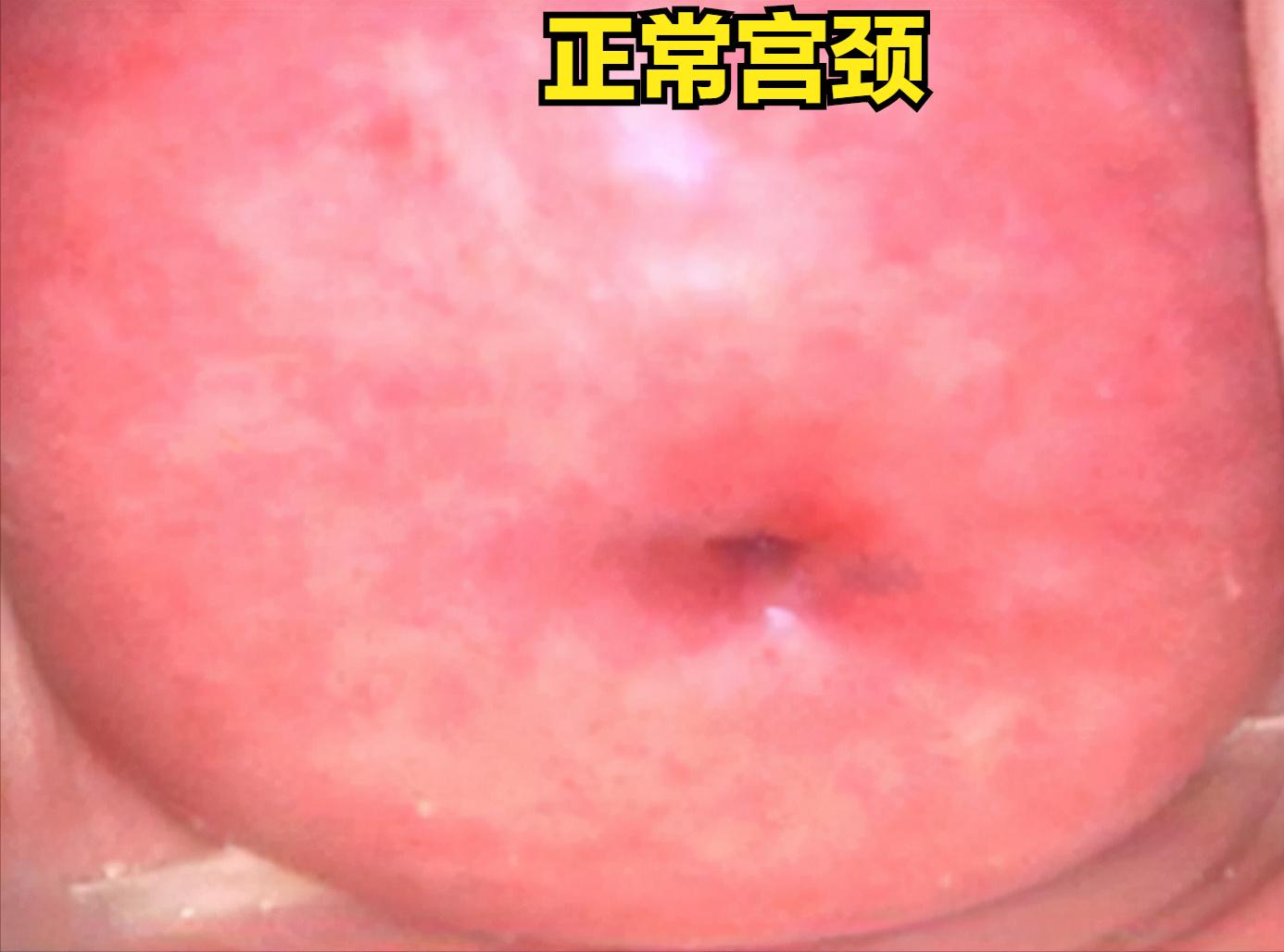 男性得hpv高危与低危的区别,男女患hpv的概率一样吗