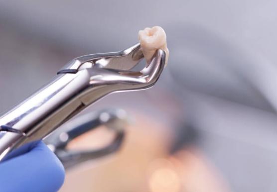 拔牙没拔干净有残根有什么影响吗,拔牙的牙洞一般多久完全愈合