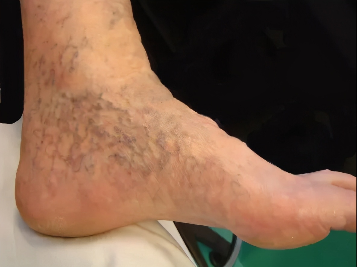 三伏天有没有必要穿袜子,三伏天能穿弹力袜吗