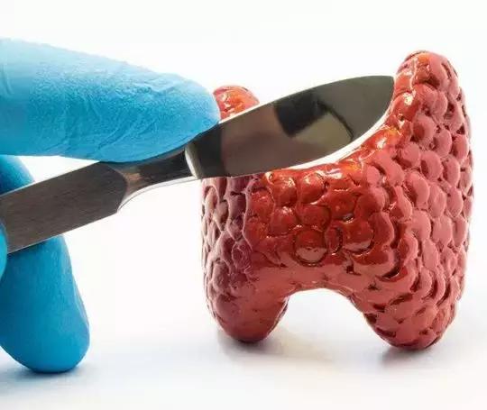 ti-rads3类甲状腺结节用做手术吗,甲状腺结节ti-rads3类要不要切除