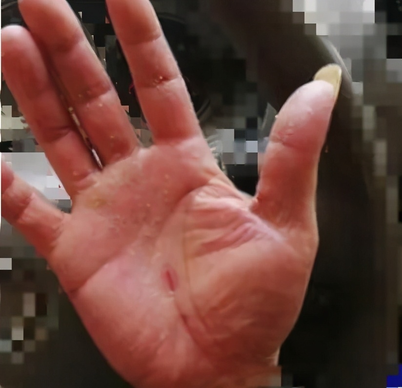 湿疹手裂口怎么办求妙招,绝望的主妇意大利