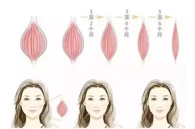 瘦脸针三针是否真的定型,瘦脸针是什么原理有副作用吗