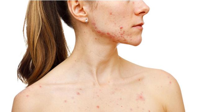 脖子出现小肉刺是怎么回事,脖子出现的小肉疙瘩是怎么引起的