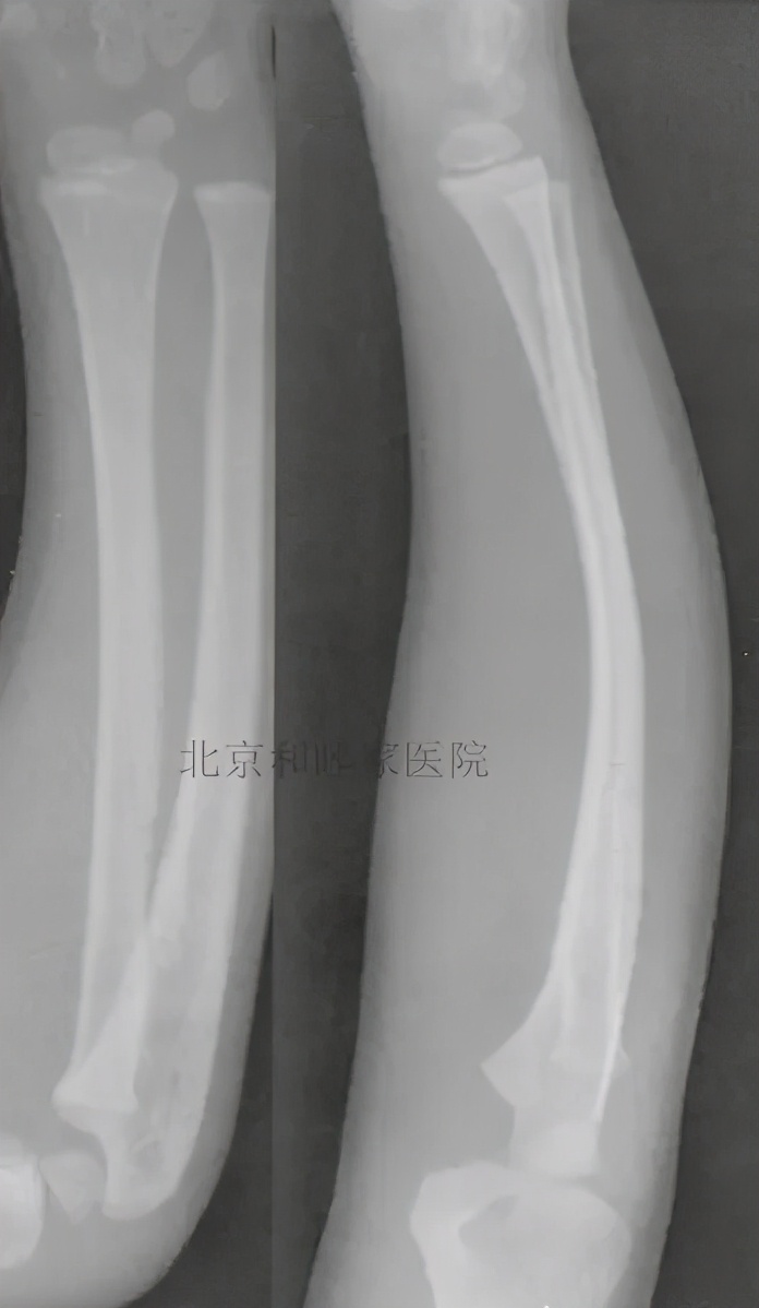 儿童骨折最佳治疗方案,儿童骨折最快恢复方法