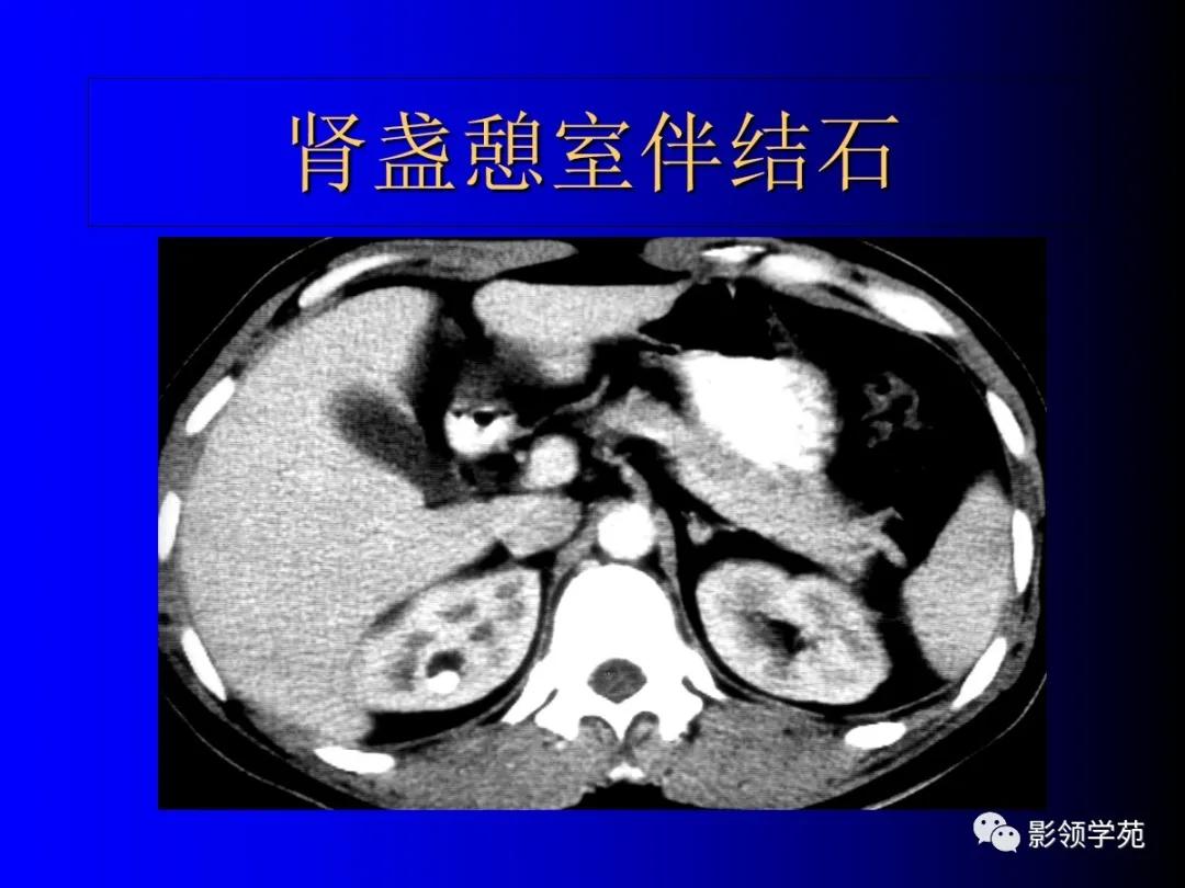 肾脏囊性肿块的影像学特点,肾脏典型病理图片及解析